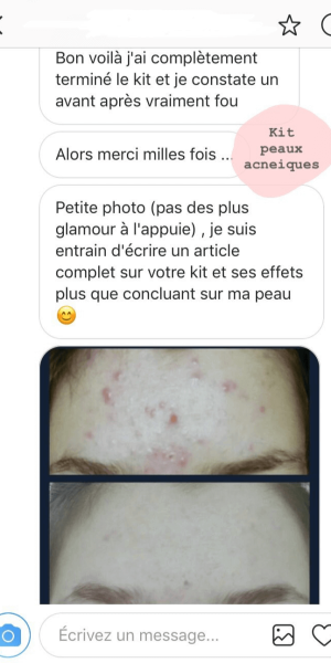 Avis-layering-acne-paima